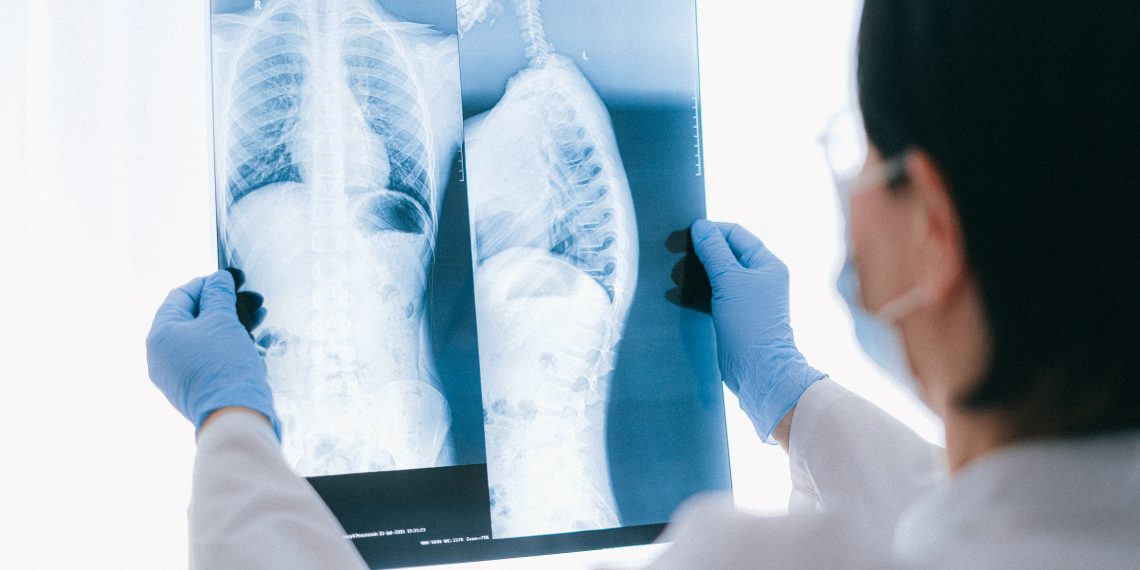 Asbestos-Related Lung Cancer vs. Mesothelioma: Key Differences