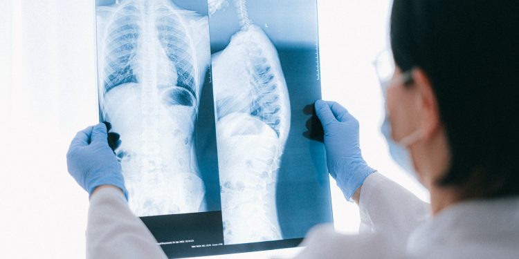 Asbestos-Related Lung Cancer vs. Mesothelioma: Key Differences
