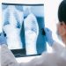 Asbestos-Related Lung Cancer vs. Mesothelioma: Key Differences